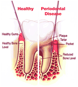 Gum Disease