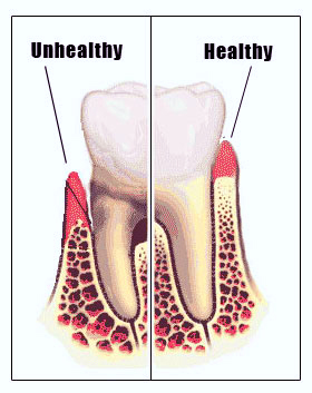 Gum Disease