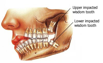 impacted wisdom teeth removal recovery time